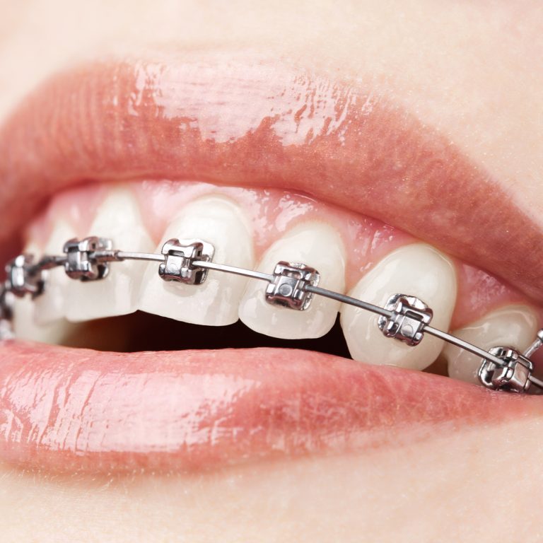 Teeth with braces